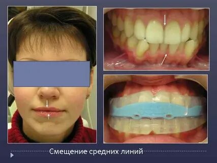 Миофункциональная коррекция