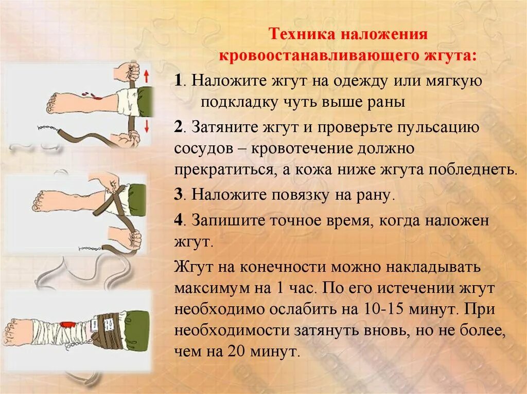 Техника наложения кровоостанавливающего жгута. Техника наложения жгута при артериальном кровотечении. Методика наложения кровоостанавливающего жгута. При правильном наложении кровоостанавливающего жгута на конечность:. При каком виде кровотечения необходимо наложить жгут