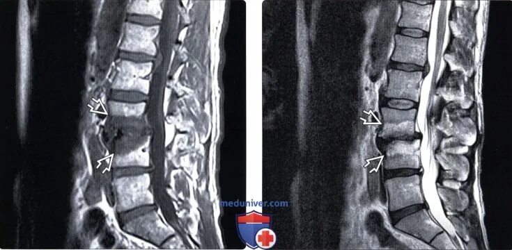 Склероз замыкательных пластин l-1 - s-1. Субхондральный склероз замыкательных пластин th2-th12. Modic 1 мрт. Пластинок тел l1-s1 позвонков.