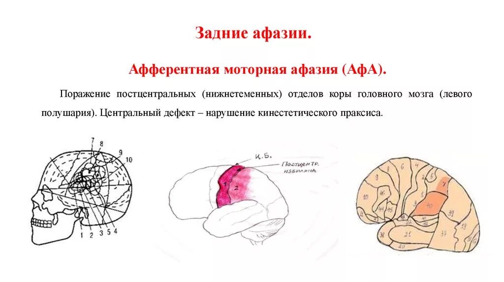 Центр афазии. Очаг поражения при афферентной моторной афазии. сенсорная афазия зона поражения. афазия головного мозга моторная. афферентная моторная афазия локализация очага поражения.