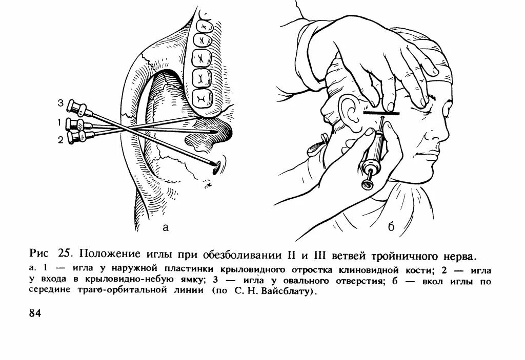 Блокада тройничного. Невралгия тройничного нерва схема. Блокада II ветви тройничного нерва.. Обезболивание 2 ветви тройничного нерва у круглого отверстия. Методики выключения второй и третьей ветвей тройничного нерва..