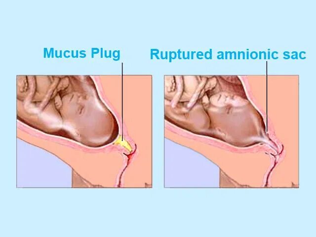 Пробка при беременности за сколько до родов. Отходят воды у беременных.