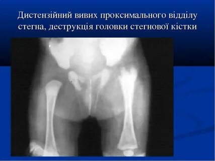 Остеомиелит у детей