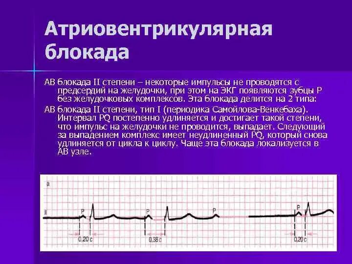 Полная атриовентрикулярная блокада. Полная АВ блокада на ЭКГ описание. ЭКГ-критерии полной АВ-блокады. Аб блокада 1 степени на ЭКГ. ЭКГ при АВ блокаде 3 степени.