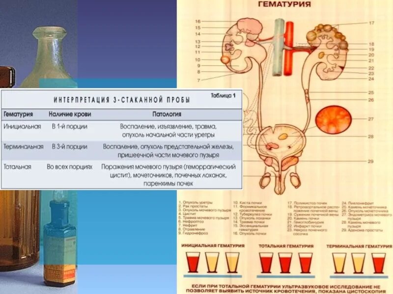 Трехстаканная проба мочи. Мочекаменная болезнь гематурия. Гематурия инициальная терминальная тотальная. Гемокрия это. Умеренная гематурия.