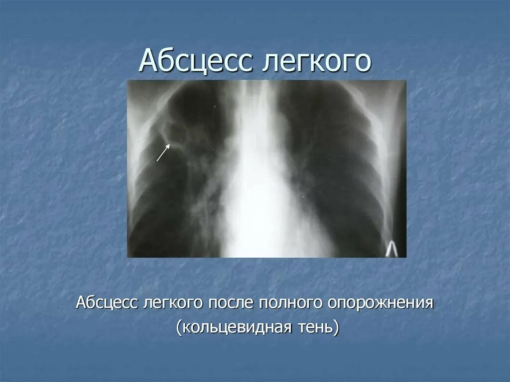 После абсцесса легкого. Кольцевидная тень на флюорографии. Кольцевидная тень в легком рентген. Абсцесс на рентгенограмме кольцевидная тень.