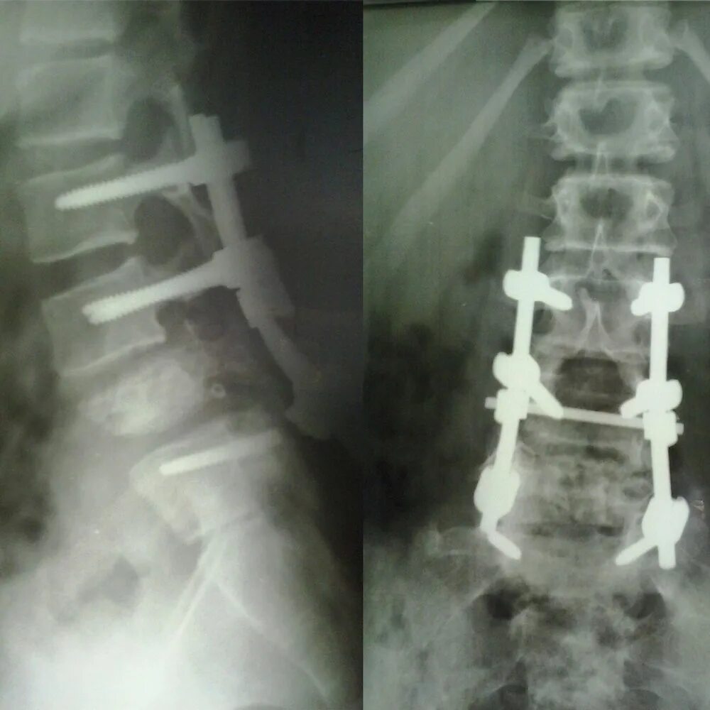 Лечение последствия компрессионного перелома позвоночника. Оскольчатый перелом l5 позвонка. Компрессионный перелом позвоночника т6. Консолидированный компрессионный перелом позвонка l5. Компрессионный перелом позвоночника l4,l5.
