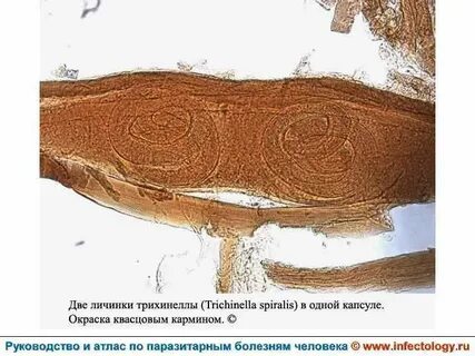 Трихинеллез аскаридоз