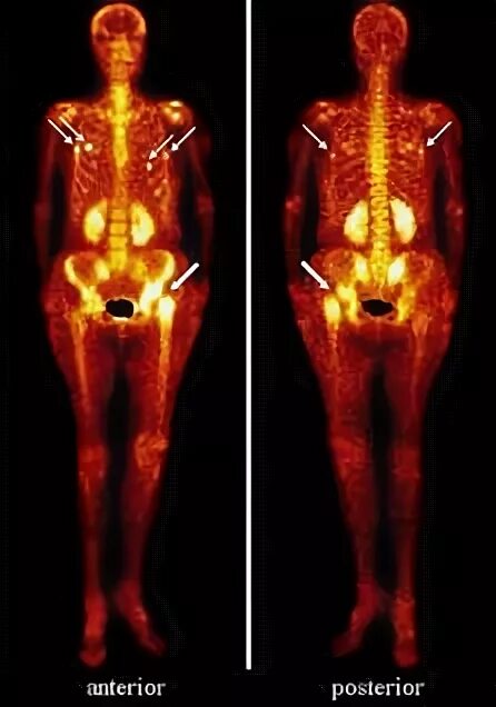 Метастатическое поражение кости. Сцинтиграфия метастазы в костях. Остеосцинтиграфия костей скелета норма. Статическая сцинтиграфия скелета. Сцинтиграфия метастазы в кости.