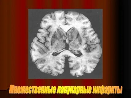 Токсическая энцефалопатия