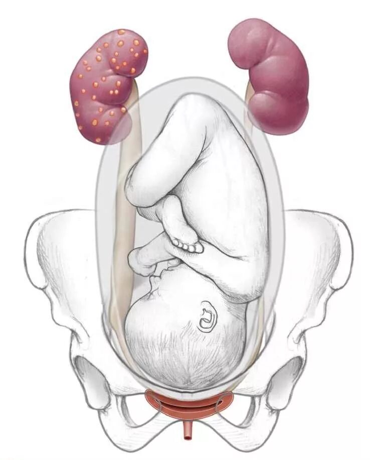 Болит почка беременность неделя. Пиелонефрит при беременности. Мочевыделительная система беременной. Гестационный гломерулонефрит. Гестационный пиелонефрит при беременности.