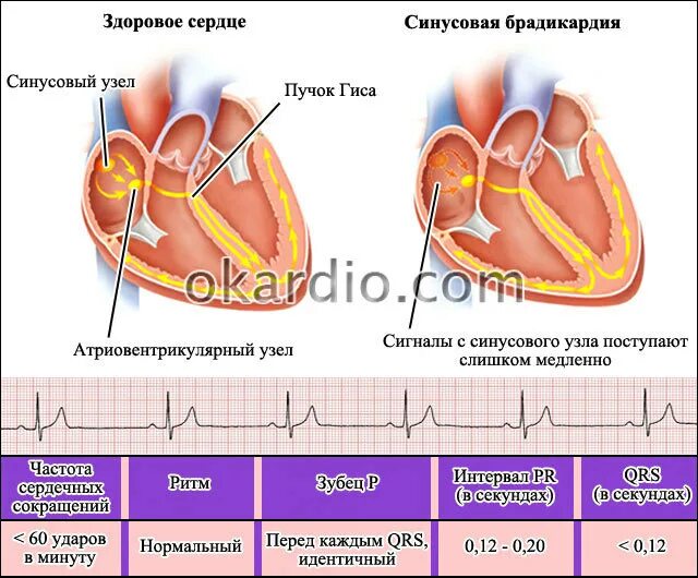 Как лечить синусовую брадикардию сердца у женщин. Брадикардия на экг. синусовая брадиаритмия сердца симптомы. брадикардия сердца что это. синусовая брадикардия сердца.