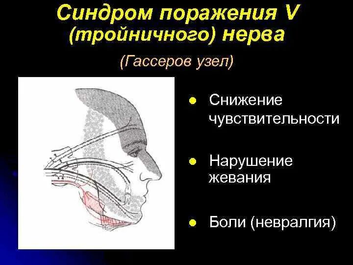 Тройничный нерв справа. Поражение ветви тройничного нерва неврология. Гассеров узел тройничного. Синдром тройничного узла. Гассеров узел тройничного нерва поражение.