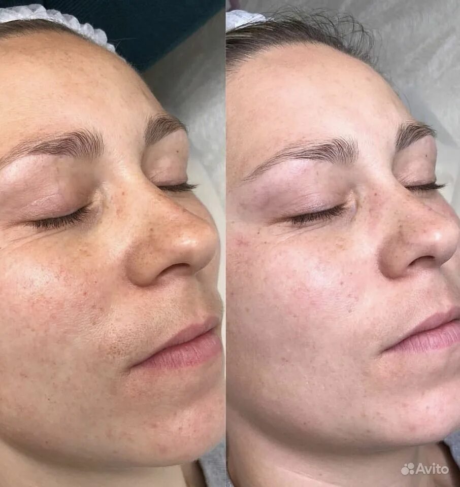 Безинъекционная (неинвазивная) карбокситерапия. Карбокситерапия маска до и после. Карбокситерапия эффект. Карбокситерапия для лица до и после. Карбокситерапия ангиофарм.
