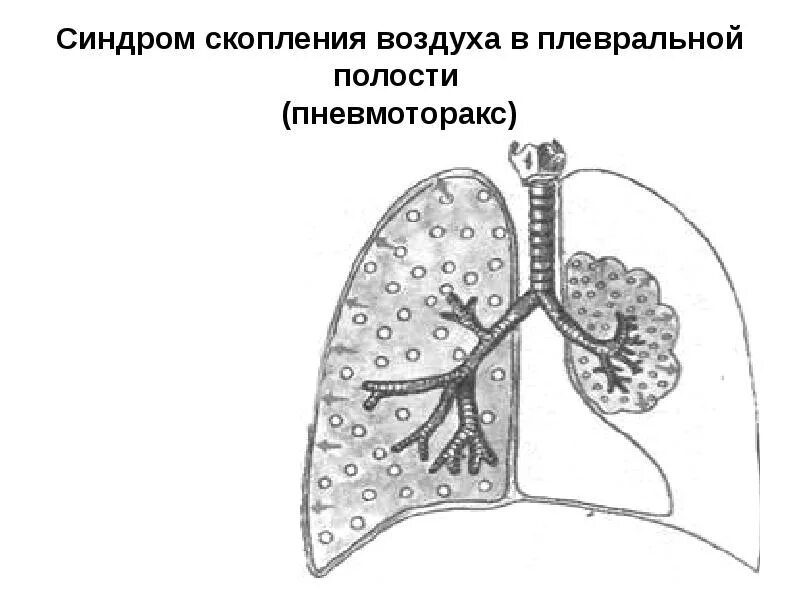 Закончился воздух в легких. Синдром скопления воздуха в плевральной полости (пневмоторакс). синдром пневмоторакса пропедевтика. синдром воздуха в плевральной полости пропедевтика. синдром скопления воздуха в плевральной полости.