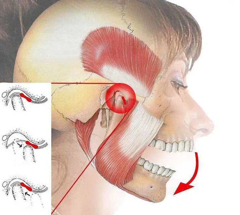 Выпала боль. Артроз височно-нижнечелюстного сустава.