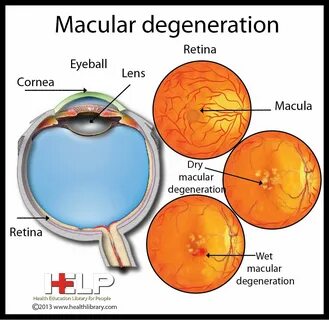 Age related macular degeneration