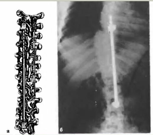 Конструкция позвоночника операция. Операция Харрингтона сколиоз. Метод Харрингтона сколиоз. Операция Котреля-Дюбуссе. Дистрактор Харрингтона.
