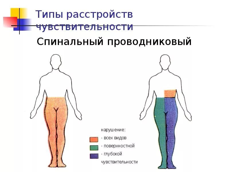 Проводников спинальный Тип нарушения чувствительности. Спинально проводниковый Тип нарушения чувствительности. Спинальный сегментарный Тип расстройства чувствительности. Гемигипестезия Тип нарушения чувствительности.