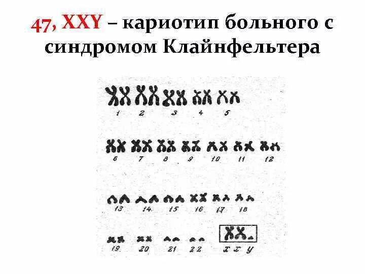 Синдром Клайнфельтера кариограмма. Кариотип больного с синдромом Клайнфельтера. Кореограмма синдрома Клайнфельтера. Кариотип больного с синдромом Клайнфельтера 47 xxy.