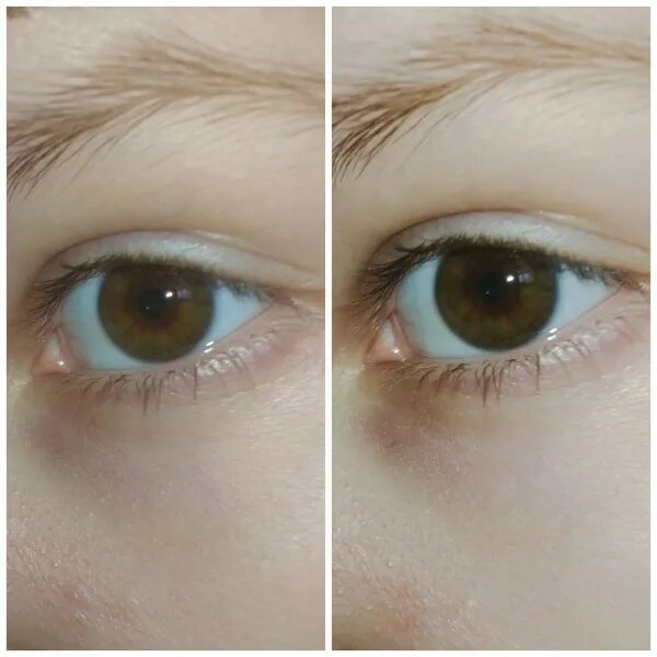 Расширенные зрачки после капель. Глаза до и после ирифрина. Ирифрин глаза до и после.
