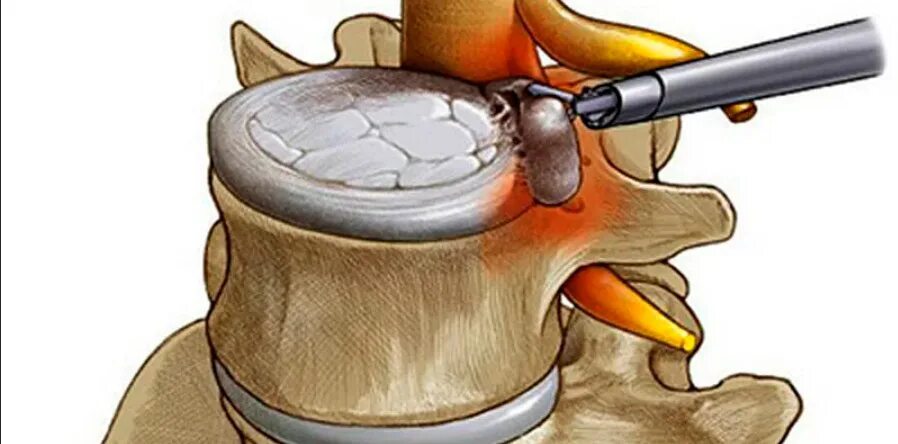 Удаление грыжи в пояснице. Эндоскопическая дискэктомия грыжи позвоночника. Межпозвонковая грыжа операция. Грыжа межпозвонкового диска операция. Эндоскопическая операция грыжи позвоночника.