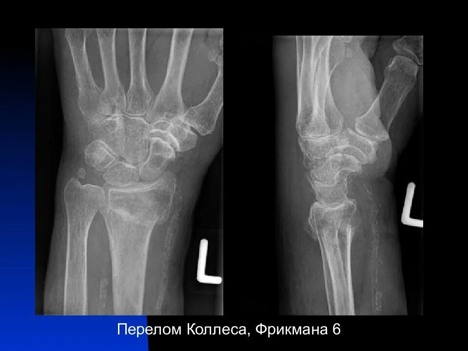 Ушиб лучезапястного. Травма лучезапястного сустава. повреждение лучезапястного сустава. ушиб лучезапястного сустава.
