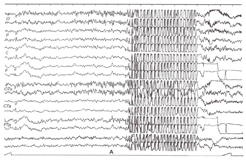 Абсансная эпилепсия на ЭЭГ. Генерализованная эпилепсия ЭЭГ. Юношеская абсанс эпилепсия ЭЭГ. Миоклоническая юношеская эпилепсия ЭЭГ паттерны. Юношеская эпилепсия
