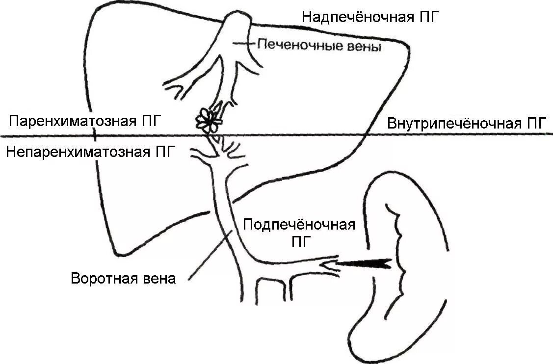 Гипертонии печень. Портальная гипертензия схема. Портальная гипертензия подпеченочный блок. Паренхиматозная портальная гипертензия. Гипертензия портальная венозное.