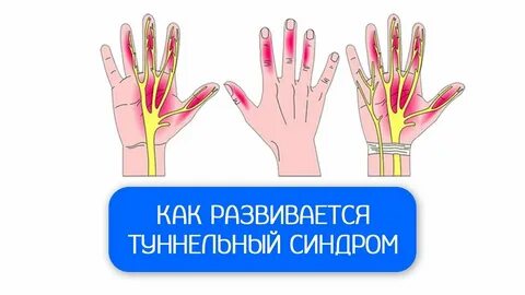 Синдром карпального канала мкб
