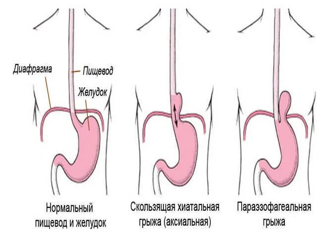 Кардиальная грыжа под. Скользящая аксиальная грыжа пищеводного отверстия 2 степени. Скользящие (аксиальные) грыжи пищеводного отверстия:. Скользящая грыжа пищевода симптомы. Кардиофундальная ГПОД.