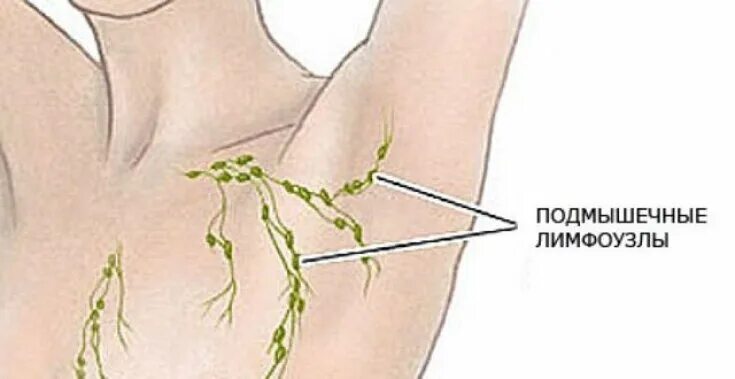 Болезненный узел. Лимфоузлы в подмышечной впадине расположение. Лимфоотток в подмышечные лимфоузлы. Лимфоузлы в подмышечной впадине у мужчин схема. Липоматоз лимфатических узлов подмышечных.