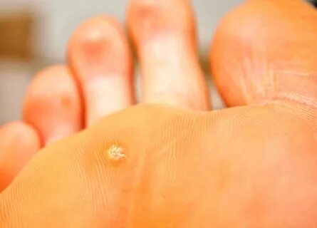 Что такое подошвенные бородавки? * клиника диана в санкт-петербурге.