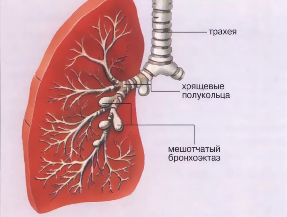 Диффузный бронхит