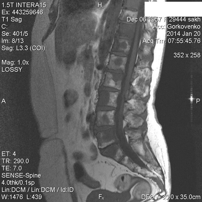 Реконверсия костного мозга мрт позвоночника. Отек костного мозга в смежных отделах l5-s1 позвонков. Отёк костного мозга позвоночника l5 s1. С5-с6 субхондральный отек костного мозга. Участки отека костного мозга