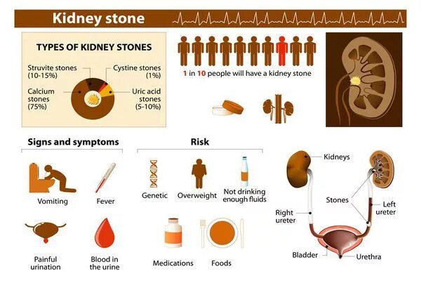 5 Kidney stone symptoms to watch out for