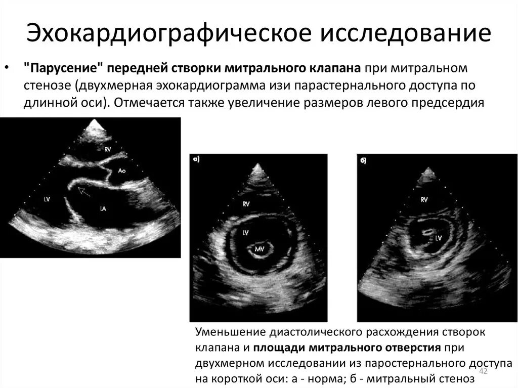 Митральный стеноз признаки. Стеноз митрального клапана по ЭХОКГ. УЗИ сердца при митральном стенозе. ЭХОКГ при митральном стенозе. ЭХОКГ при стенозе митрального клапана.