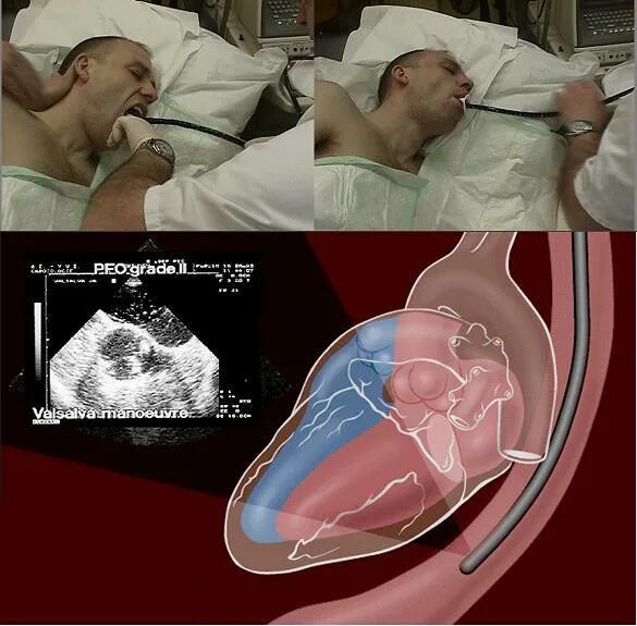 Как проходят эхо. Чреспищеводное УЗИ сердца. Чреспищеводная эхокардиоскопия. Чреспищеводная эхокардиография. Эхокардиография через пищевод.