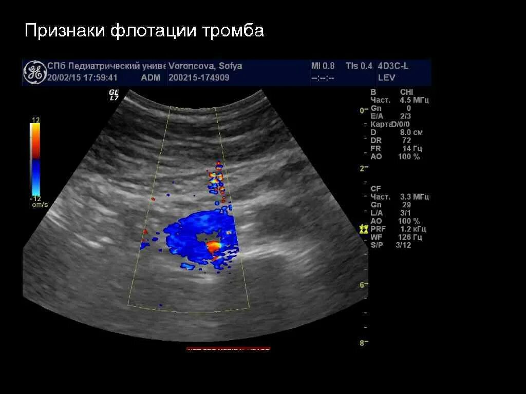 Флотирующий тромб. Флотирующий тромбоз узи.