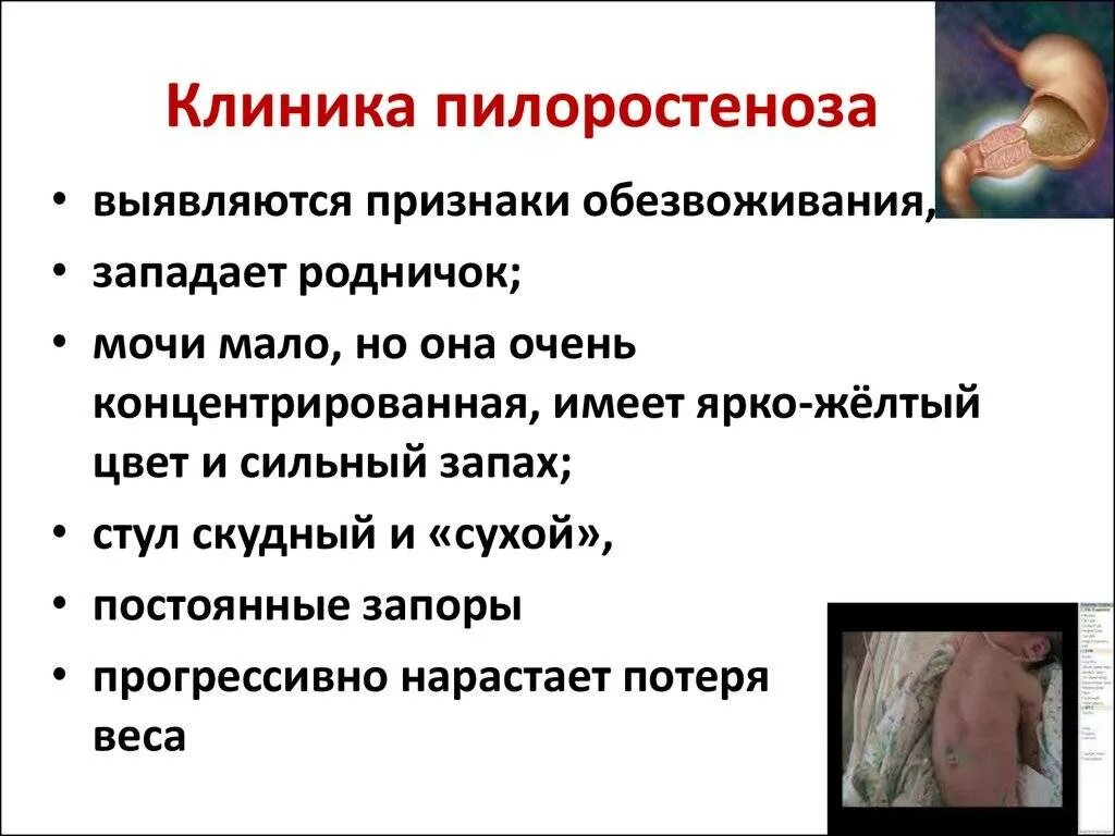 Врожденный гипертрофический пилоростеноз. Клиника пилороспазма и пилоростеноза. Пилоростеноз у новорожденных. Симптомы песочные часы