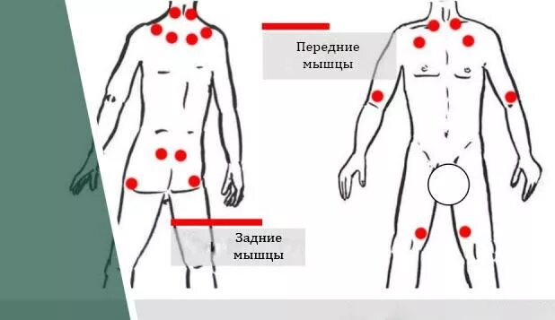Фибромиалгия симптомы. Фибромиалгия болевые точки. фибромиалгия точки. фибромиалгия болезненные точки.