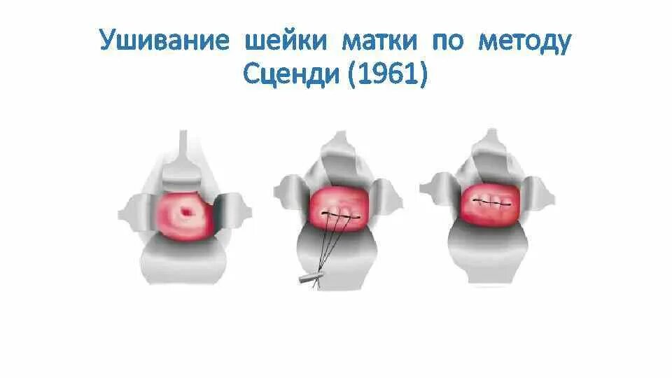 Методы зашивания разрывов шейки матки. Наложение шва на шейку матки. Шейка матки швы операция. Круговой шов на шейку матки. Швы при ицн