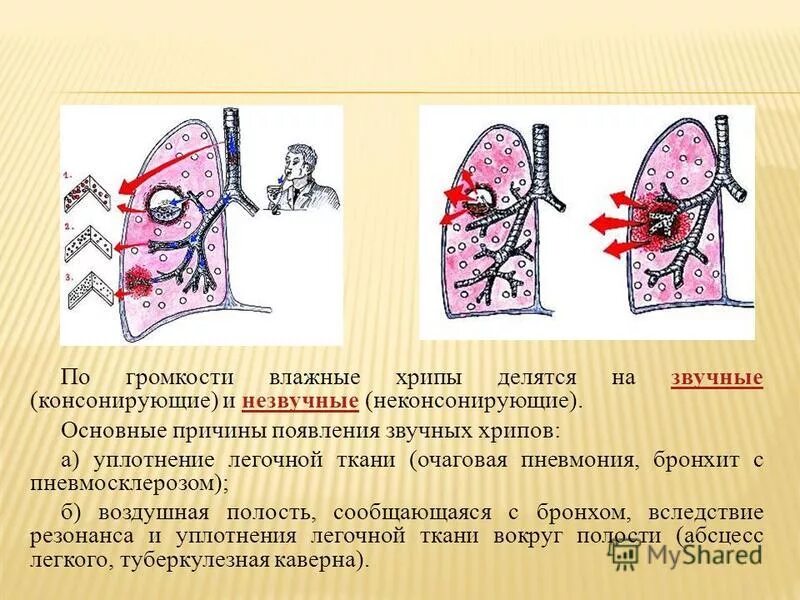 Хрипы в легких. Хрипы в легких при дыхании. Хрипы в легких при вдохе. Хрипы в легких при выдохе у взрослого. При кашле свист при выдохе