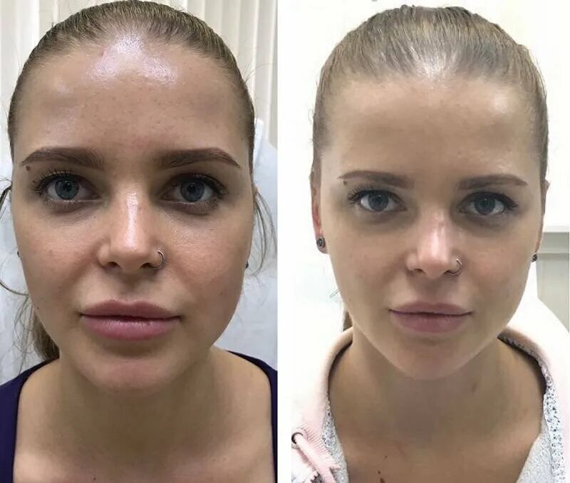 Липофилинг губ до и после. Новакутан с био. Посл 0. Косметология худое лицо до и после. Посл 0.