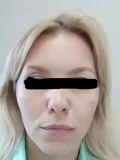 Птоз фото