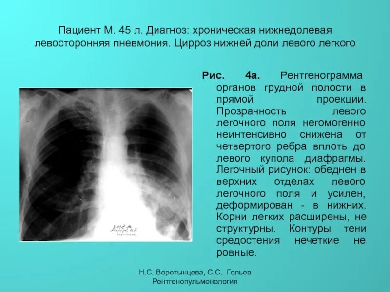 Поствоспалительные изменения в легких что это. Правосторонняя нижнедолевая очаговая пневмония рентген. Нижнедолевая очаговая пневмония рентген. Левосторонняя нижнедолевая пневмония рентген. Левосторонняя нижнедолевая пневмония рентгенограмма.