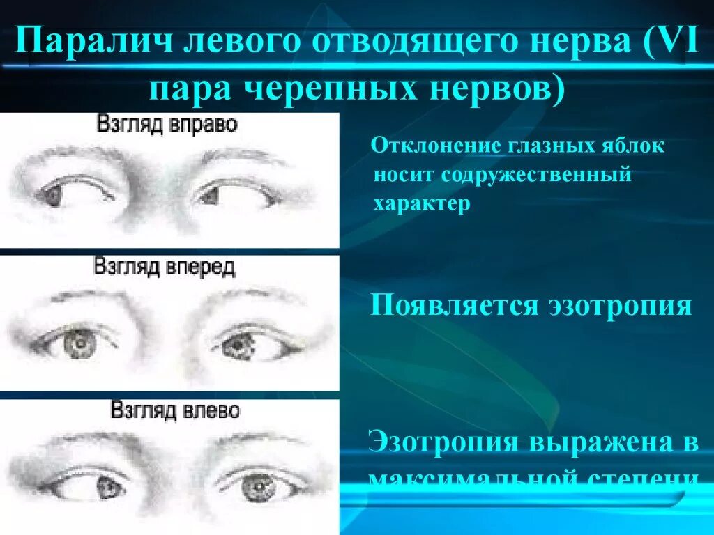 Нарушение движения глаз. Парез 6 пары отводящего нерва. Паралич отводящего нерва. Симптомы поражения отводящего нерва. Парез отводящего нерва глаза.