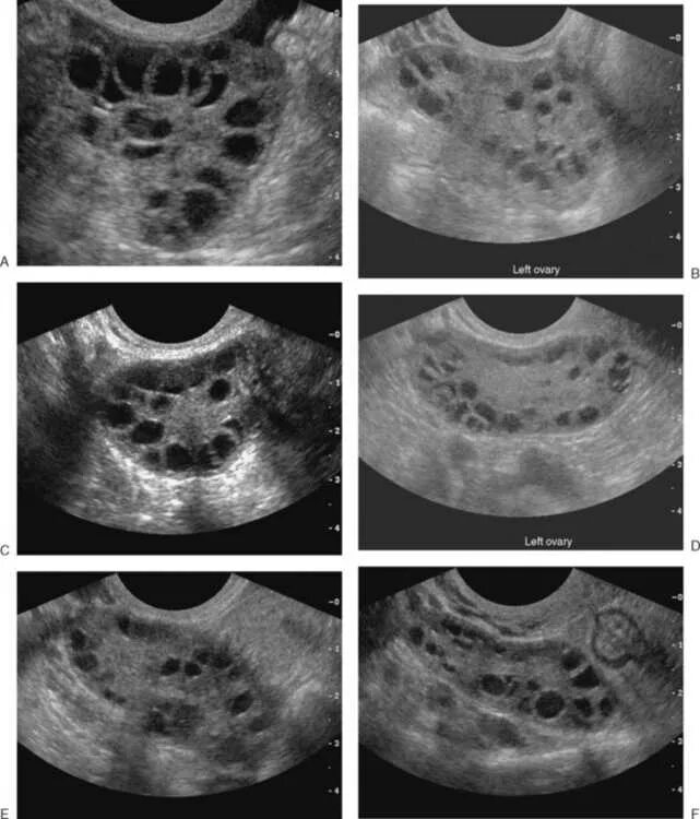 Синдром поликистоза яичников на УЗИ. Мультифолликулярные поликистоз яичников. Фолликулярный поликистоз. Поликистоз яичников и мультифолликулярные яичники. Мфя в гинекологии что