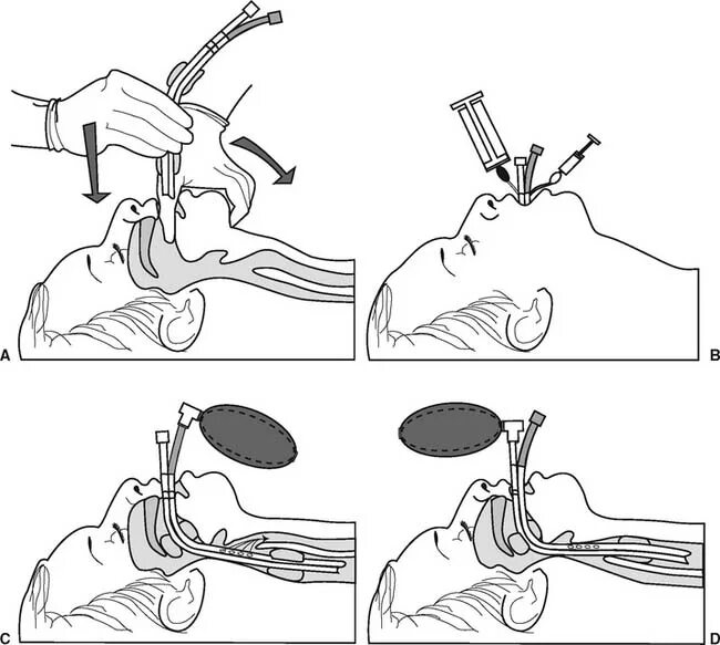 Трубка при наркозе. Интубация трахеи алгоритм. Ларингоскоп для интубации. Интубация трахеи через нос. Интубация трахеи при наркозе.