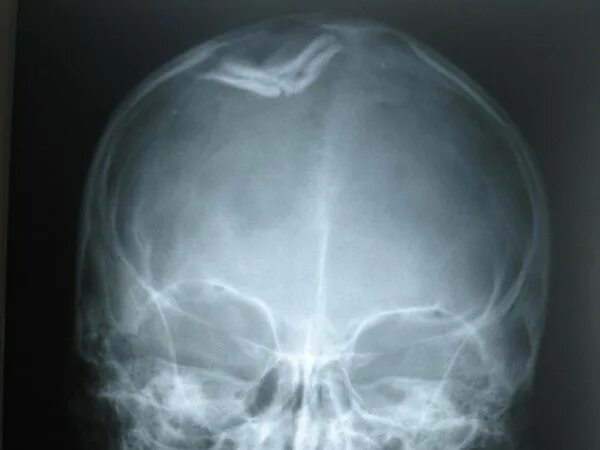 Трещина в голове. Вдавленный перелом костей черепа рентген. Перелом теменной кости черепа рентген. Перелом костей основания черепа рентген. Черепно мозговая травма с переломом костей черепа.